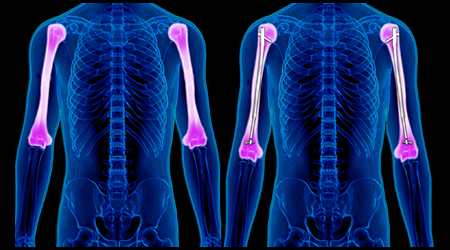 BILATERAL HUMERAL LENGTHENING (ARMS)