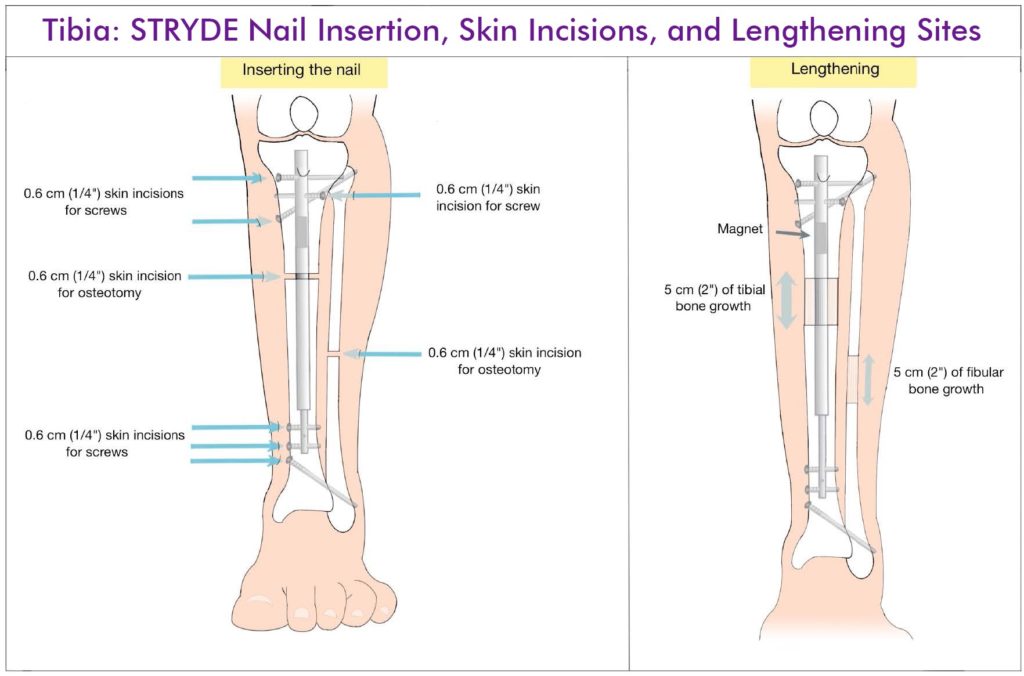 Tibia Lengthening with STRYDE