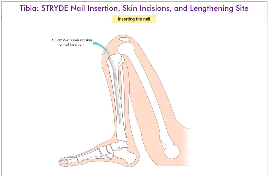 Tibia Lengthening with STRYDE
